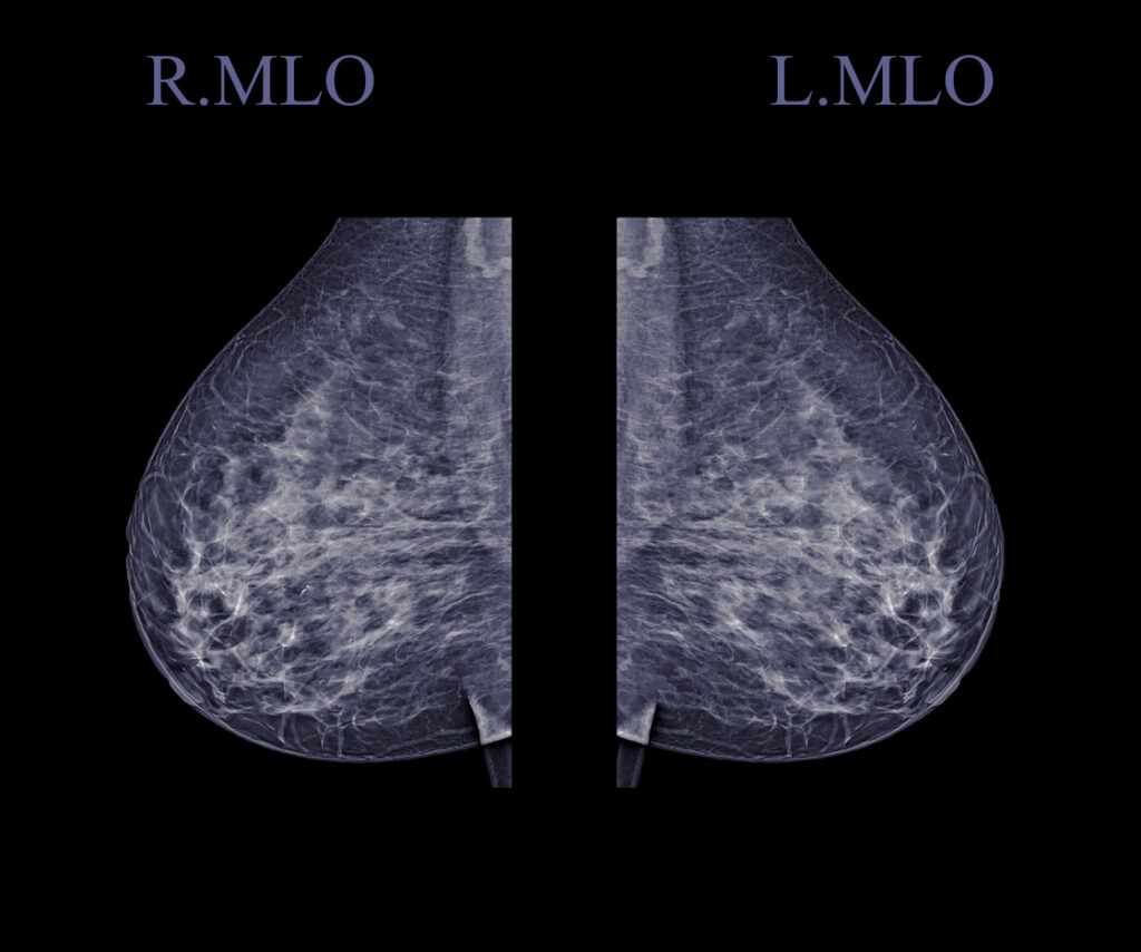X-ray Digital Mammogram of both side of the breast